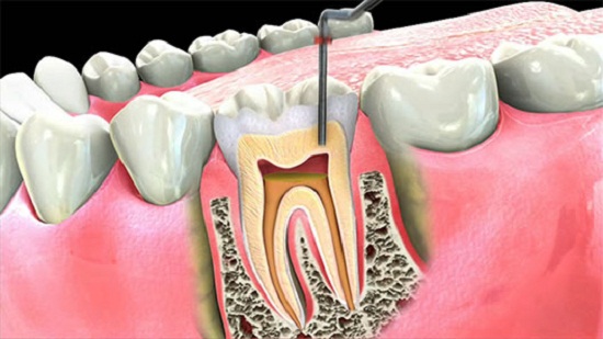 Root canal treatment