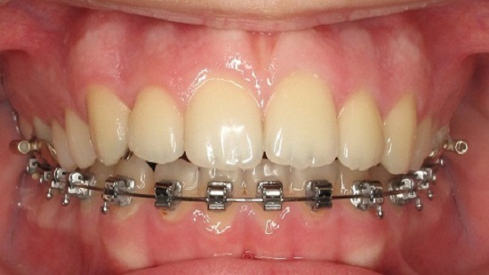 Treatment of Irregular Teeth