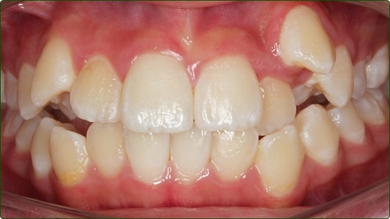 Treatment of Irregular Teeth