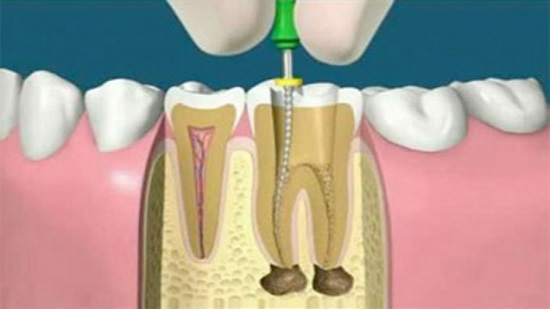 Root canal treatment