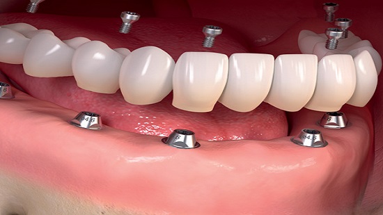 Dental implants