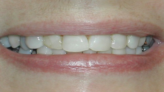 Cosmetic Dental Work