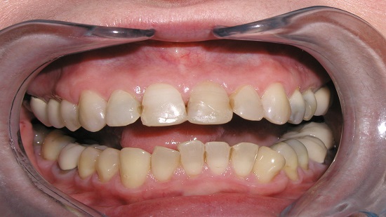 Cosmetic Dental Work